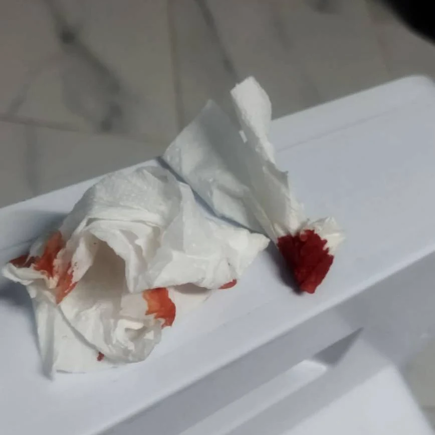 Blood-stained crumpled tissues on white surface suggesting recent nosebleed