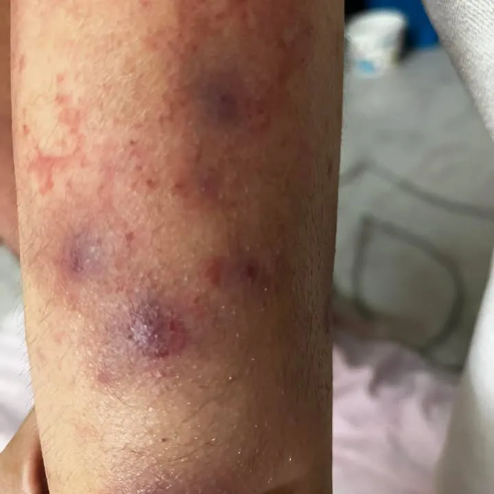 Clustered purpura and petechial rash on inner forearm