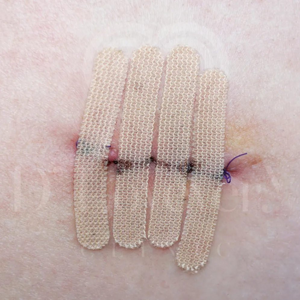 Postoperative horizontal suture line with adhesive wound-closure strips and visible stitches