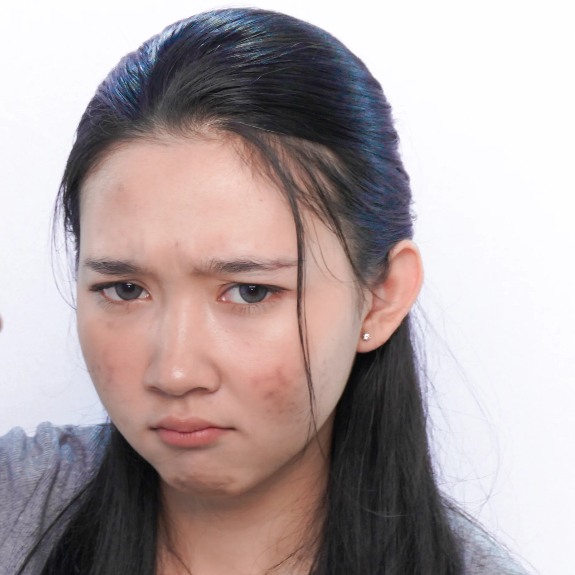 Close-up of young woman with acne scars and annoyed expression