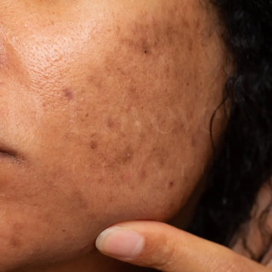 Cheek close-up showing dark spots, acne scarring, and hyperpigmentation