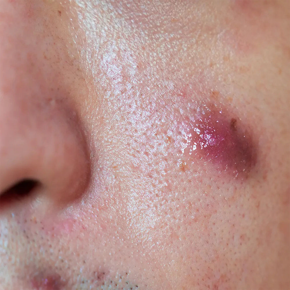 Close-up inflamed acne pimple on cheek near nostril, glossy dome with small scab