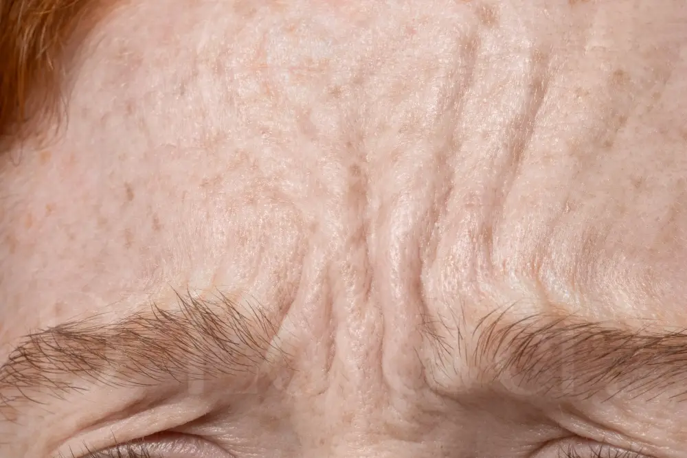 Close-up of furrowed brow and forehead wrinkles on strawberry-blond skin