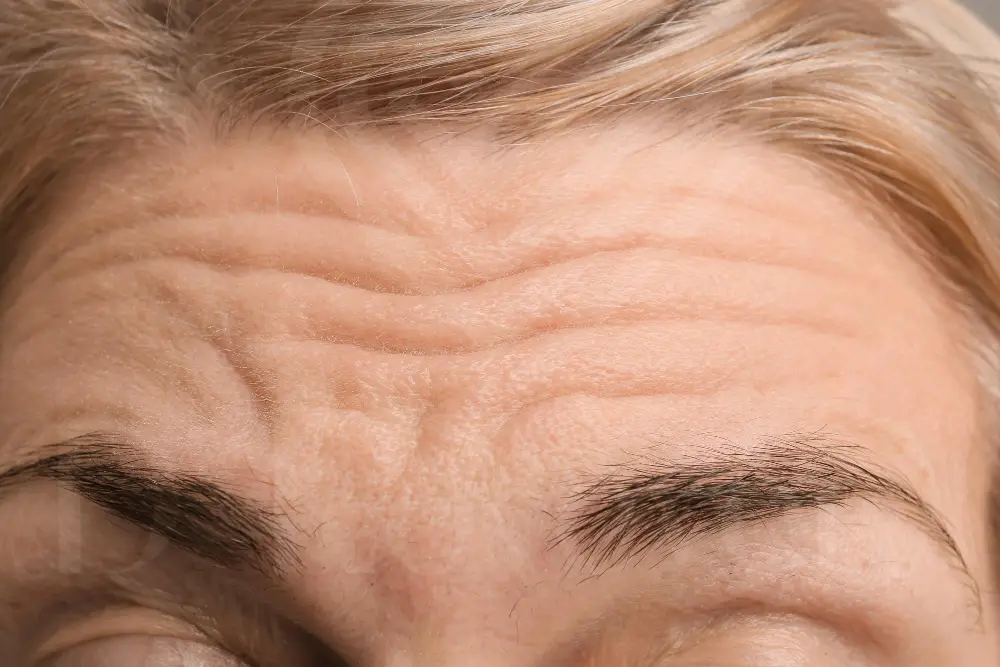 Close-up of forehead wrinkles and glabellar lines with light blond eyebrows