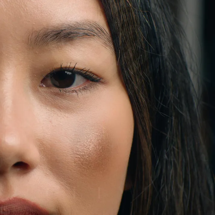 Close-up of pregnant womans left cheek melasma hyperpigmentation near eye