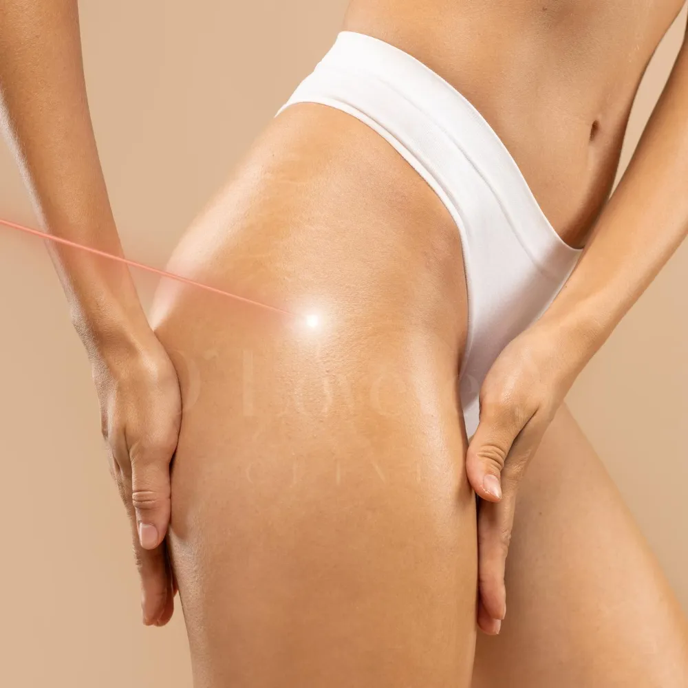 Pico laser stretch mark removal on upper thigh, clinical cosmetic treatment