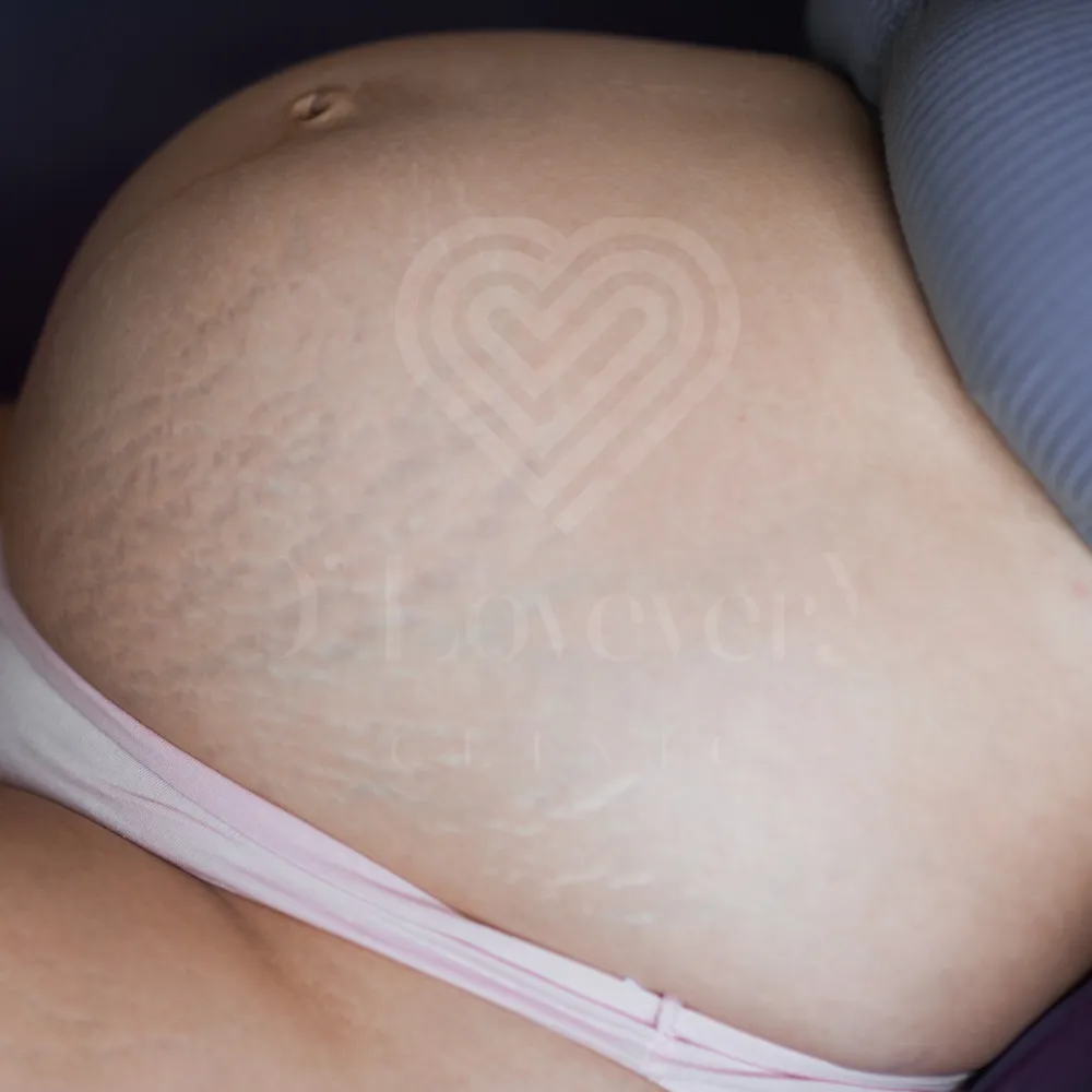 Pregnancy stretch marks on abdomen — before treatment photo