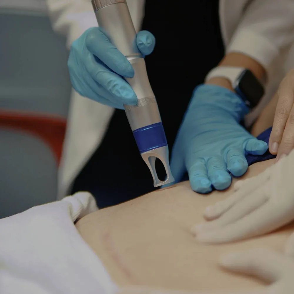 Pico laser scar removal on abdomen by gloved practitioners using handheld metallic applicator