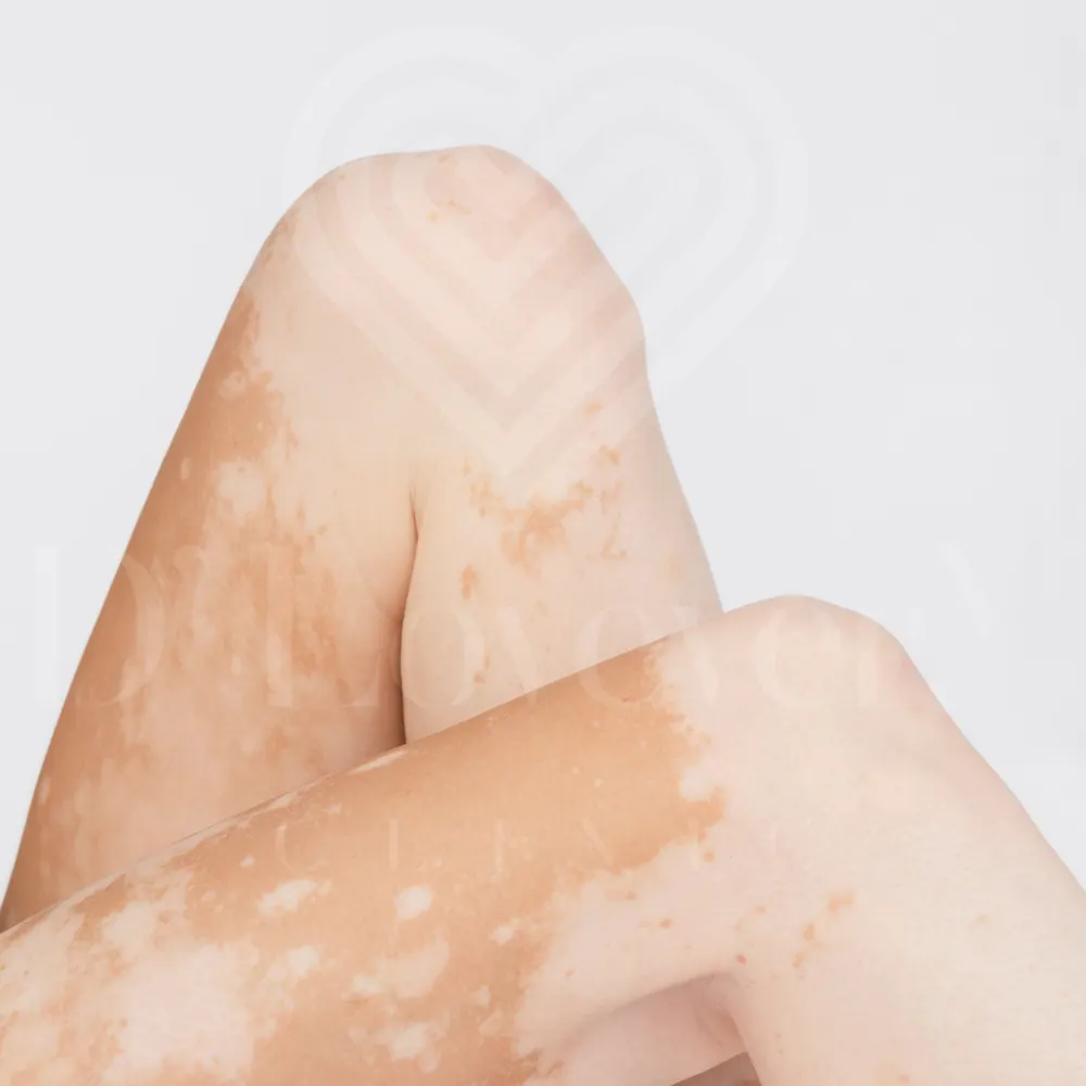 Close-up of crossed legs showing vitiligo patches on knees and shins