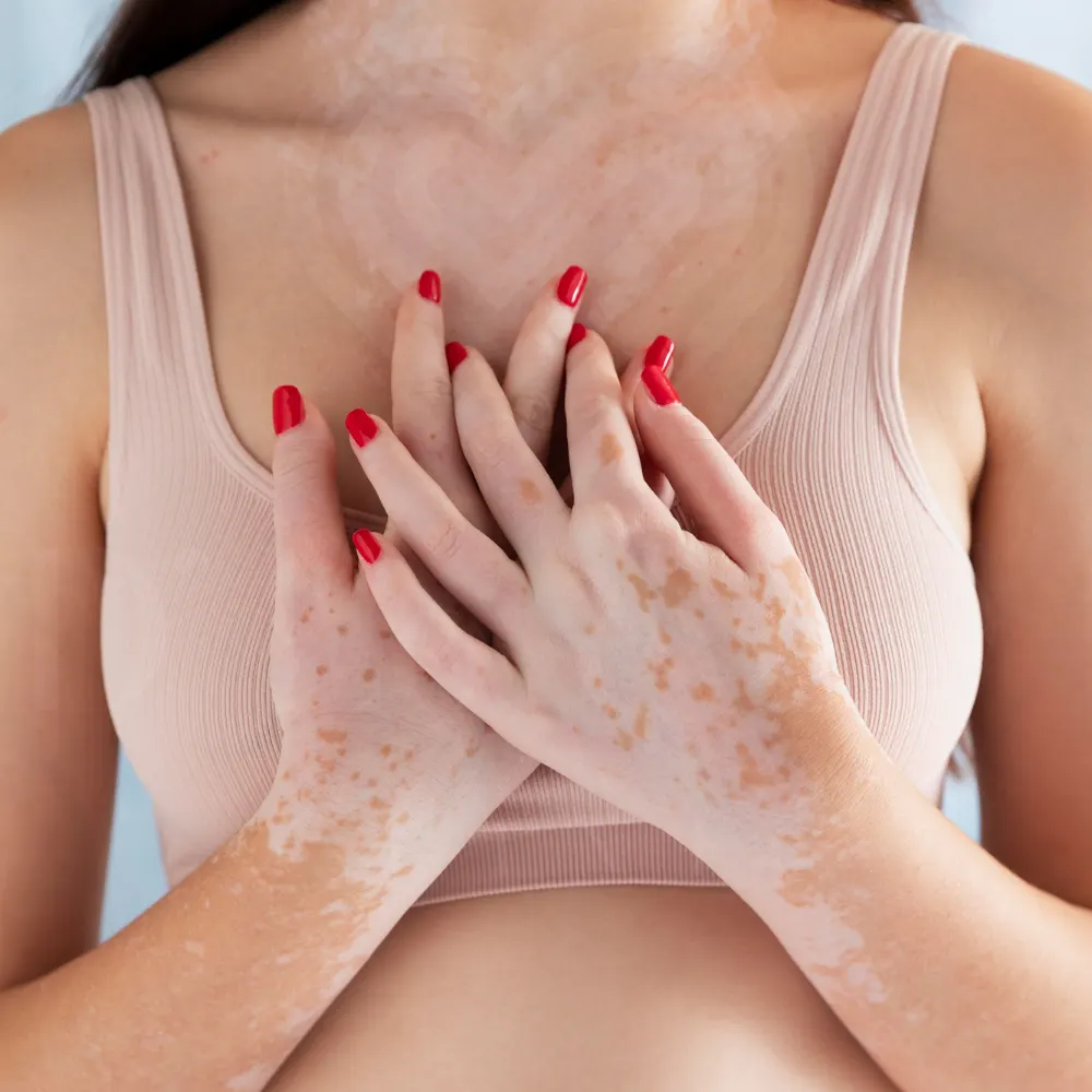 Close-up of torso in nude-pink bralette, hands with red nails and pale skin patches
