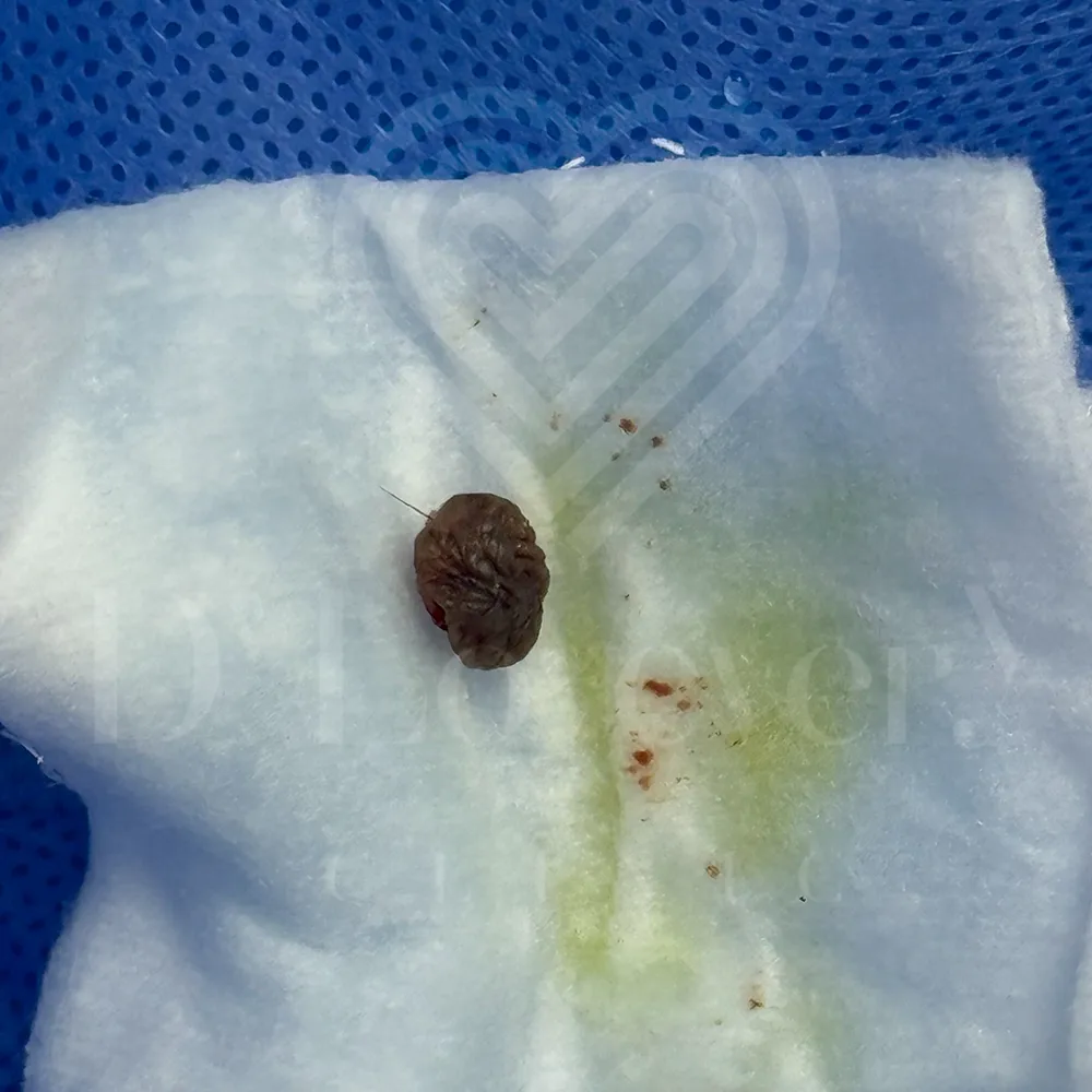 Excised brown wrinkled skin lesion mole biopsy on surgical gauze with blood specks