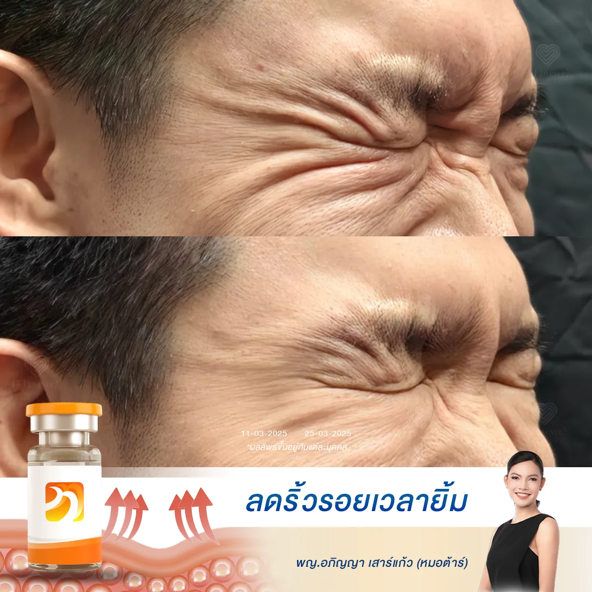 Before and after crows feet reduction on closed right eye, serum advertisement