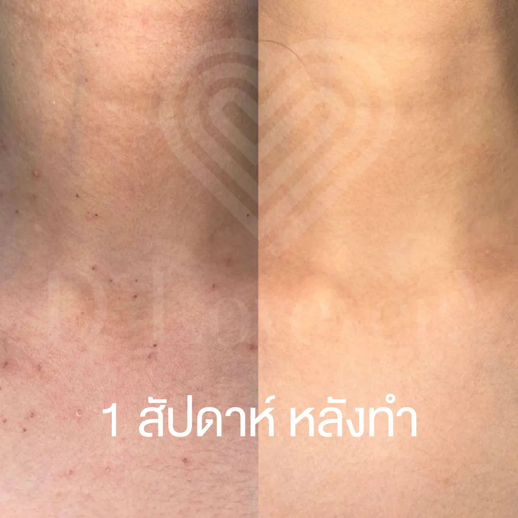 Mole removal before-and-after neck, 1 week post-treatment: smoother, more even skin