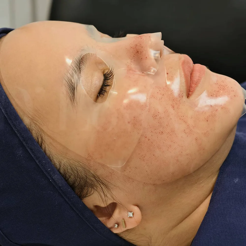 Pico laser aftercare clear hydrogel face mask soothing redness
