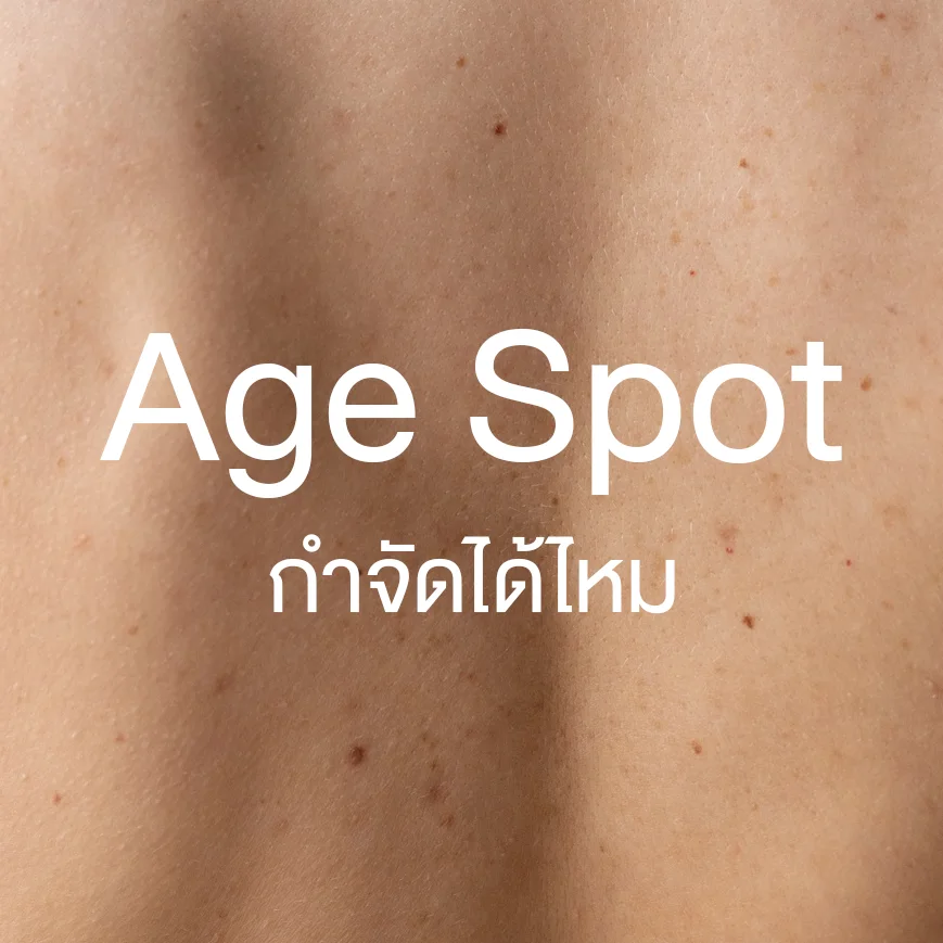 Upper back age spots on fair skin — CO2 laser removal
