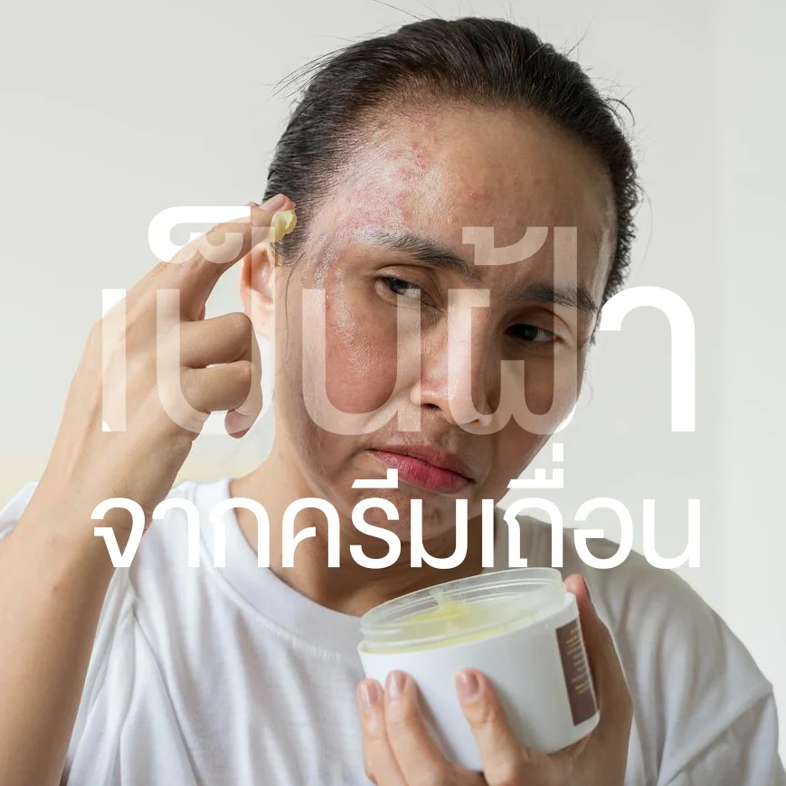 ฝ้าที่เกิดจากการใช้ครีมทาหน้า