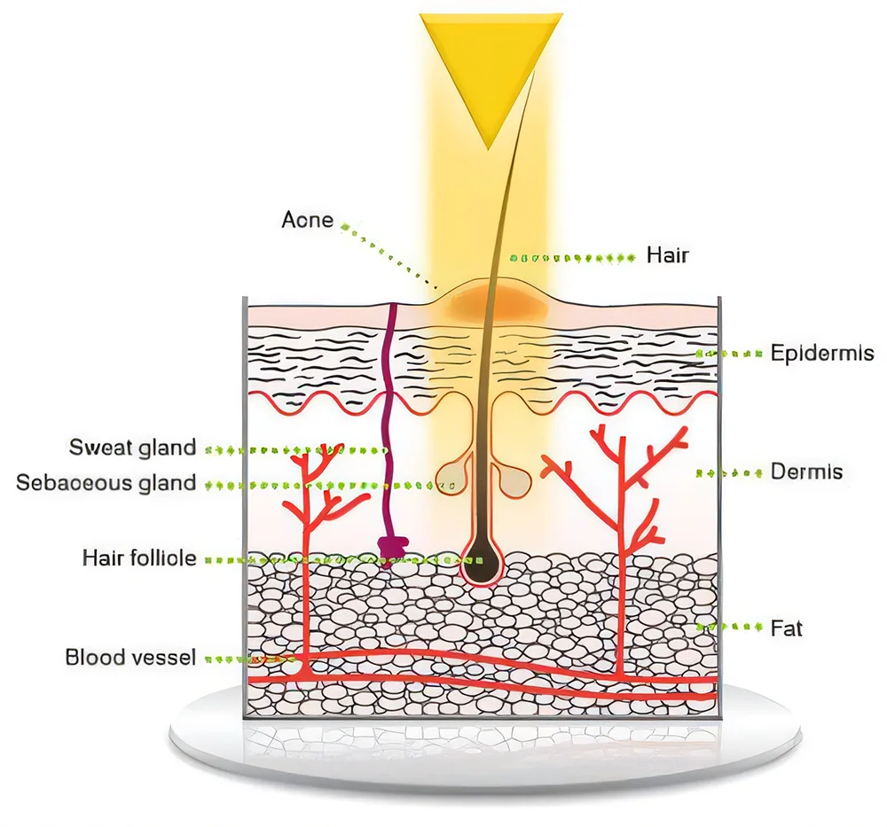 Yellow laser targets hair follicle in skin cross-section for laser hair removal