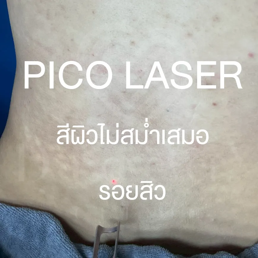 Pico laser treating acne scars and uneven skin, red targeting dot visible