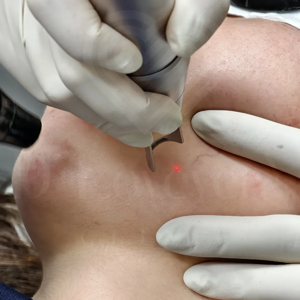 Pico laser jawline treatment with red targeting laser and gloved hands