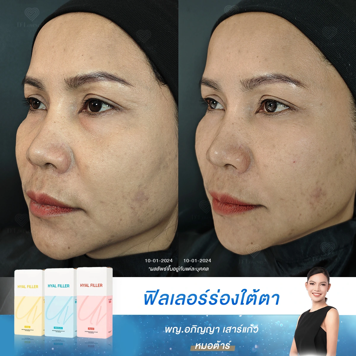 รีวิวแก้ปัญหาสิว รอยสิว และร่องใต้ตาดำคล้ำ เปลี่ยนตัวเองให้มั่นใจที่ D' Lovevery Clinic
