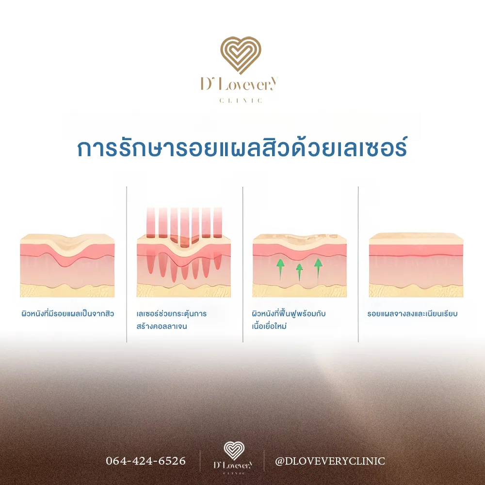 Laser treatment for acne scars: pico laser, CO2 laser.