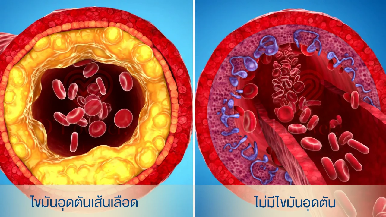 ไขมันอุดตันในเส้นเลือด แพ็คเกจตรวจเลือดหาไขมัน ตรวจสุขภาพ