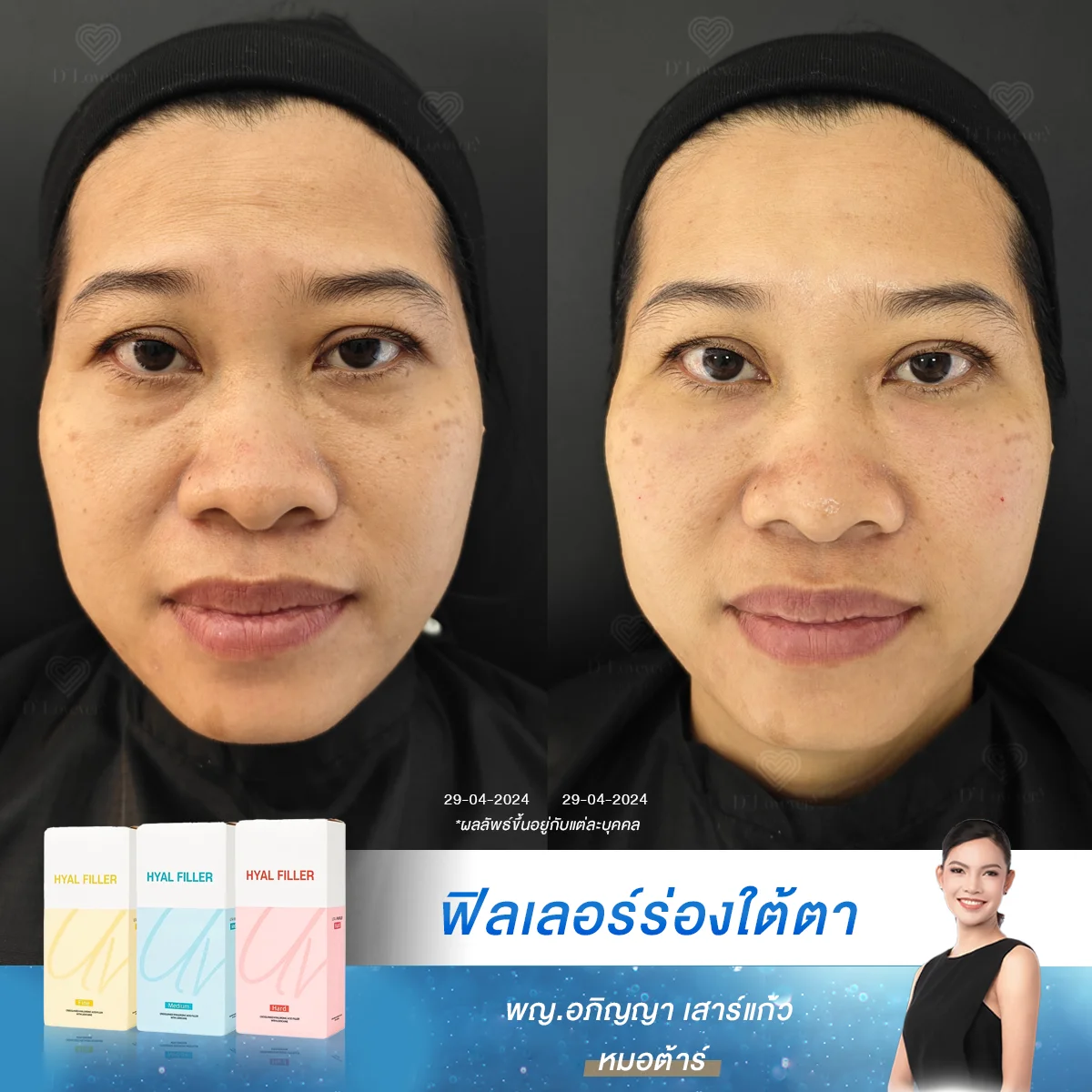 [รีวิว] ฟิลเลอร์ใต้ตา หัตถการลดอายุให้ใบหน้ายอดฮิต! ให้กลับมาสดใสทันที ที่ D’ Lovevery Clinic ถ้าทำแล้วไม่ดีจริงไม่คนไม่ทำเยอะขนาดนี้