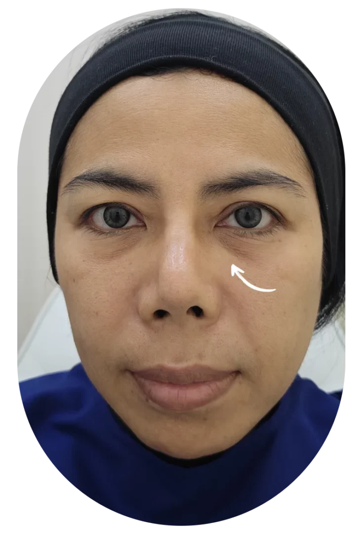 Before under-eye filler, Case 51 — close-up showing mild tear trough hollows