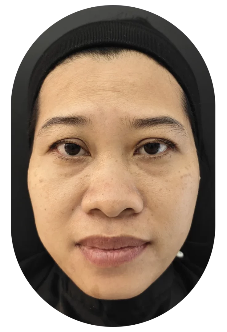 Before under-eye filler: close-up portrait of woman with headscarf showing under-eye hollows