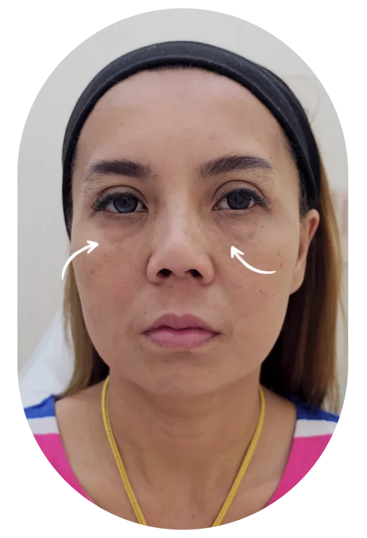 Under-eye filler before photo showing tear troughs and dark circles on adult woman