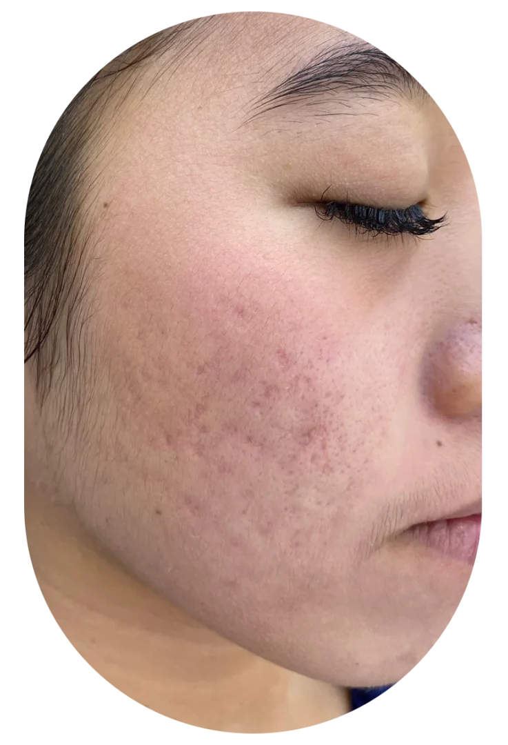 Close-up left cheek acne scars and hyperpigmentation, microneedling treatment.