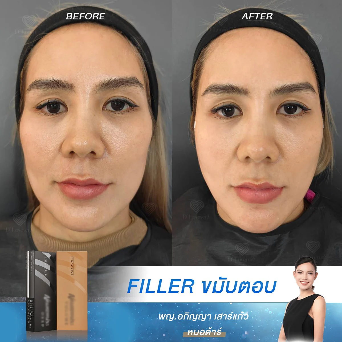 [แบบนี้ต้องกี่ cc] แก้ขมับยุบ หน้าไม่ละมุน ให้กลับมาได้รูป ด้วยฟิลเลอร์ ที่ D’Lovevery Clinic