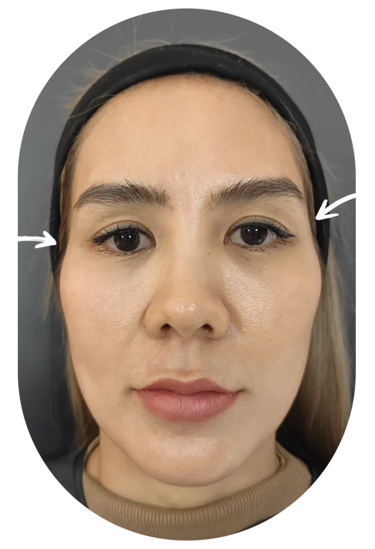 Case 54 Temple Hollow Filler 1cc Per Side