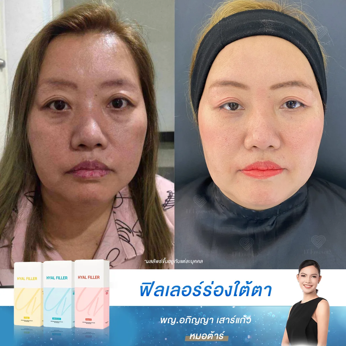 [กลัวฟิลเลอร์มาก] แต่ก็ไม่ทนกับใต้ตาที่ลึกชัดขนาดนี้ ฟิลเลอร์ใต้ตา ครั้งแรก… ใครกลัวให้มาเริ่มที่นี่ กับเรา ดีเลิฟเวอรี่คลินิก