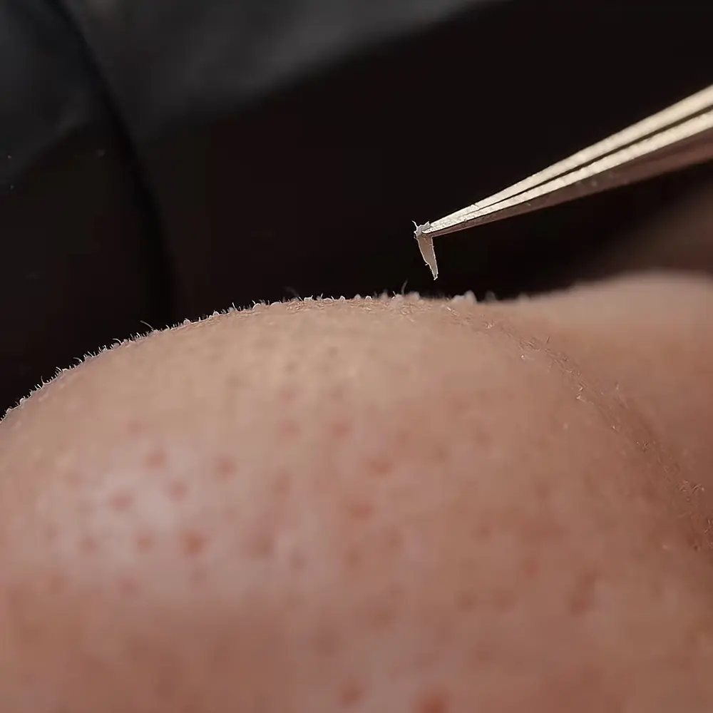 Close-up blackhead extraction with tweezers on skin