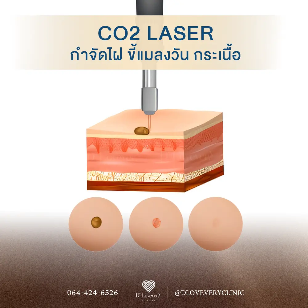 CO2 laser mole and skin tag removal cross-section illustration with before, during, after
