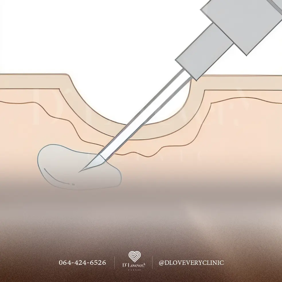Cross-section of dermal filler injection lifting a sunken acne scar.