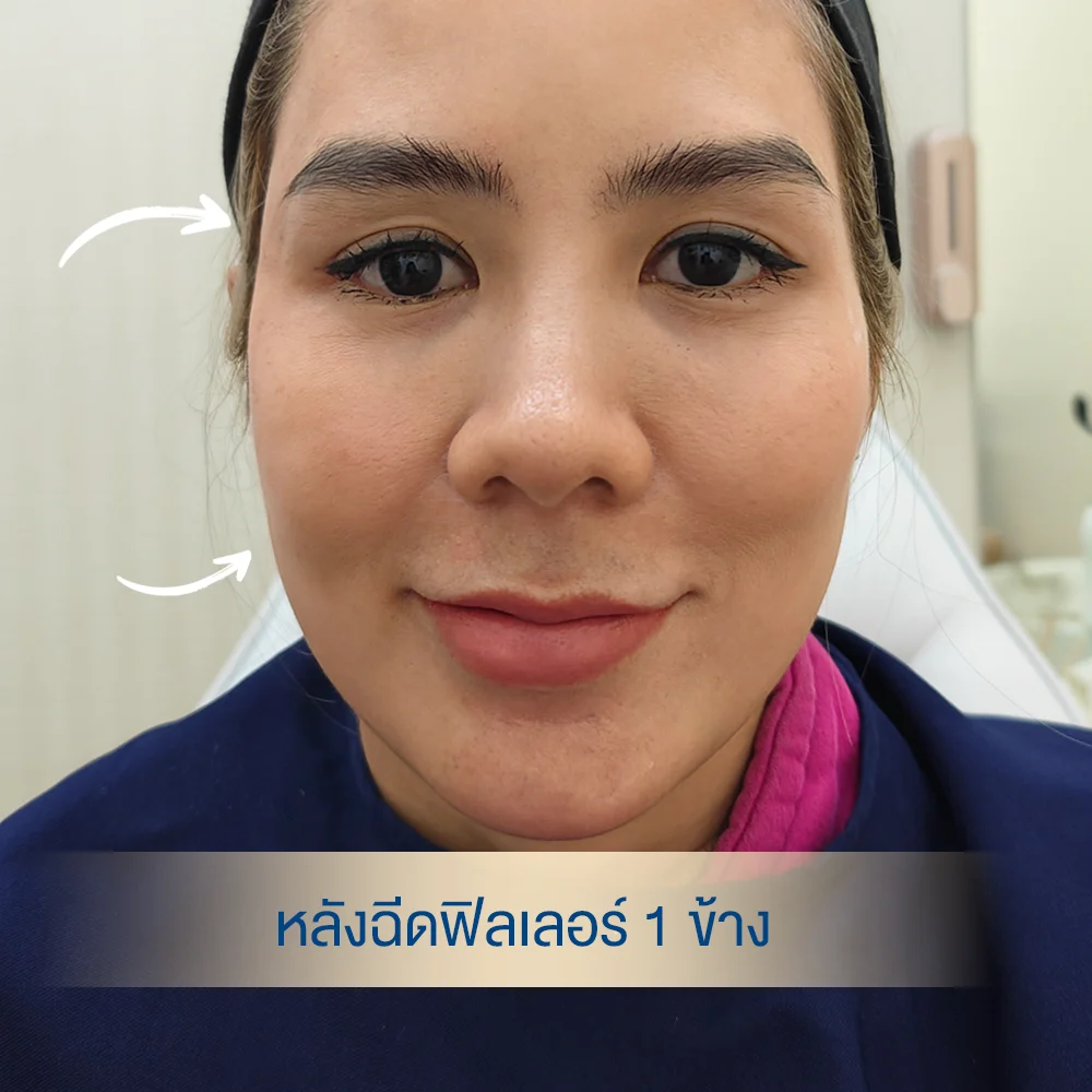 After filler: one-sided cheek and temple—subtle fullness visible.