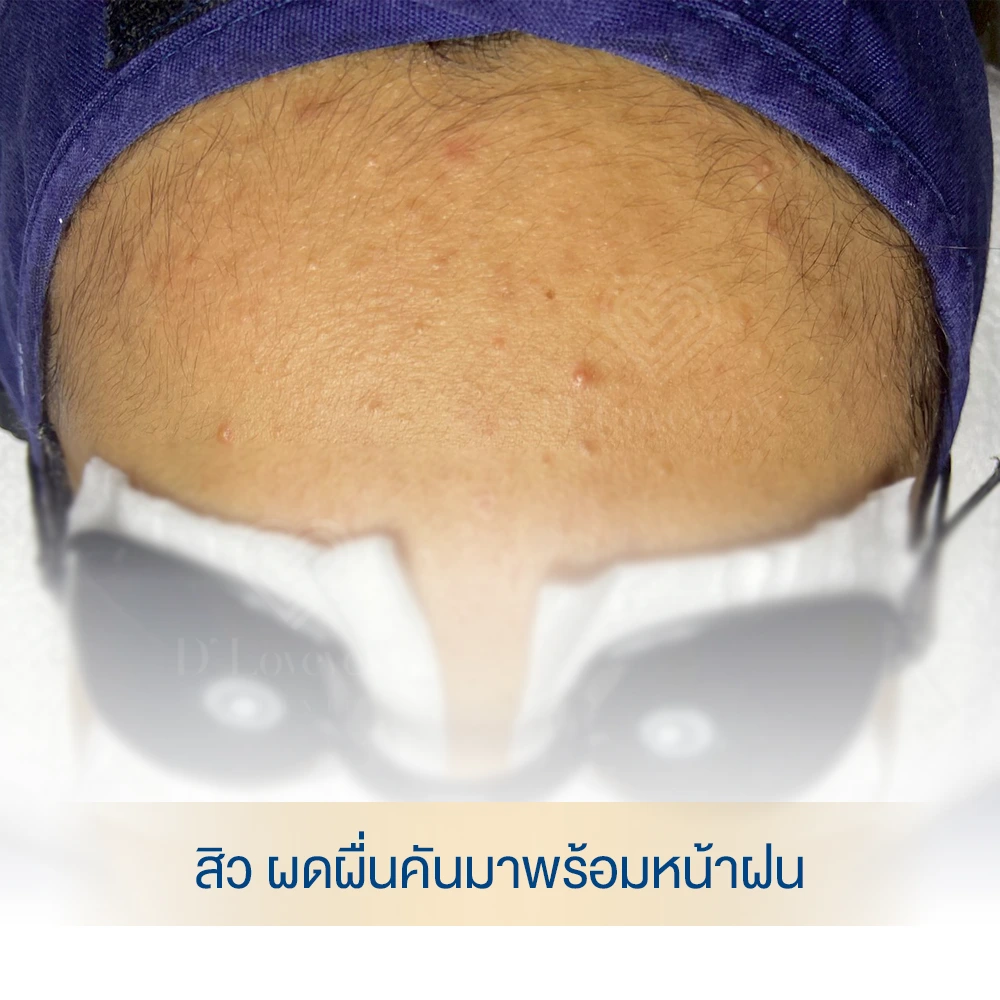 Forehead acne before treatment — rainy season skincare clinic