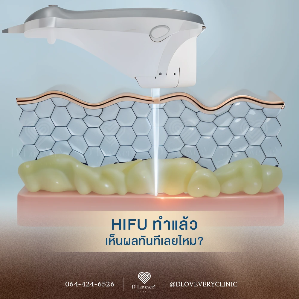 3D cross-section of HIFU device targeting subcutaneous fat with focused beam, showing results