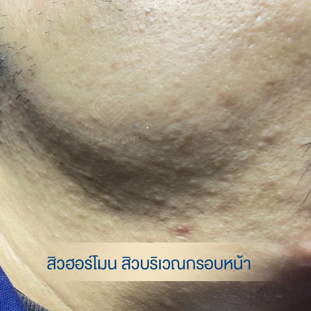 Hormonal acne close-up on jawline with inflamed spots and hyperpigmentation