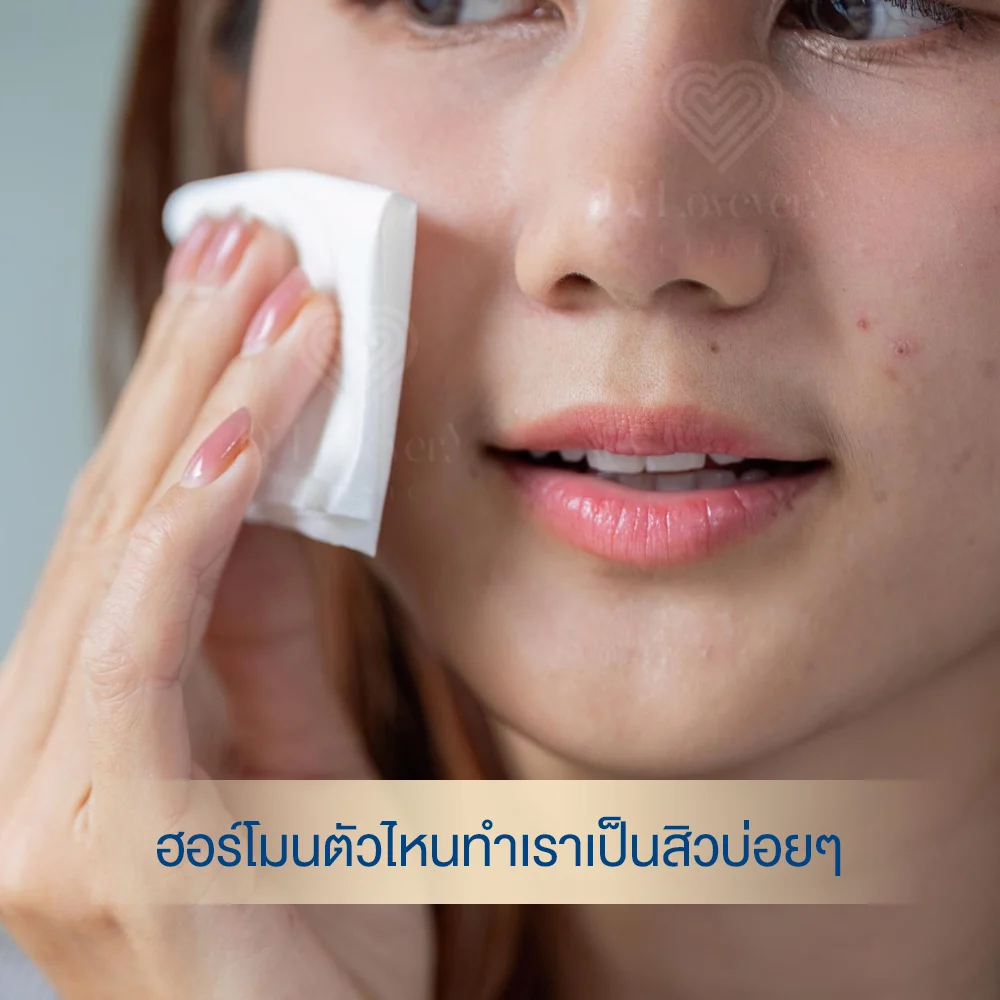 Close-up of woman gently cleansing hormonal acne with cotton pad, visible cheek blemishes