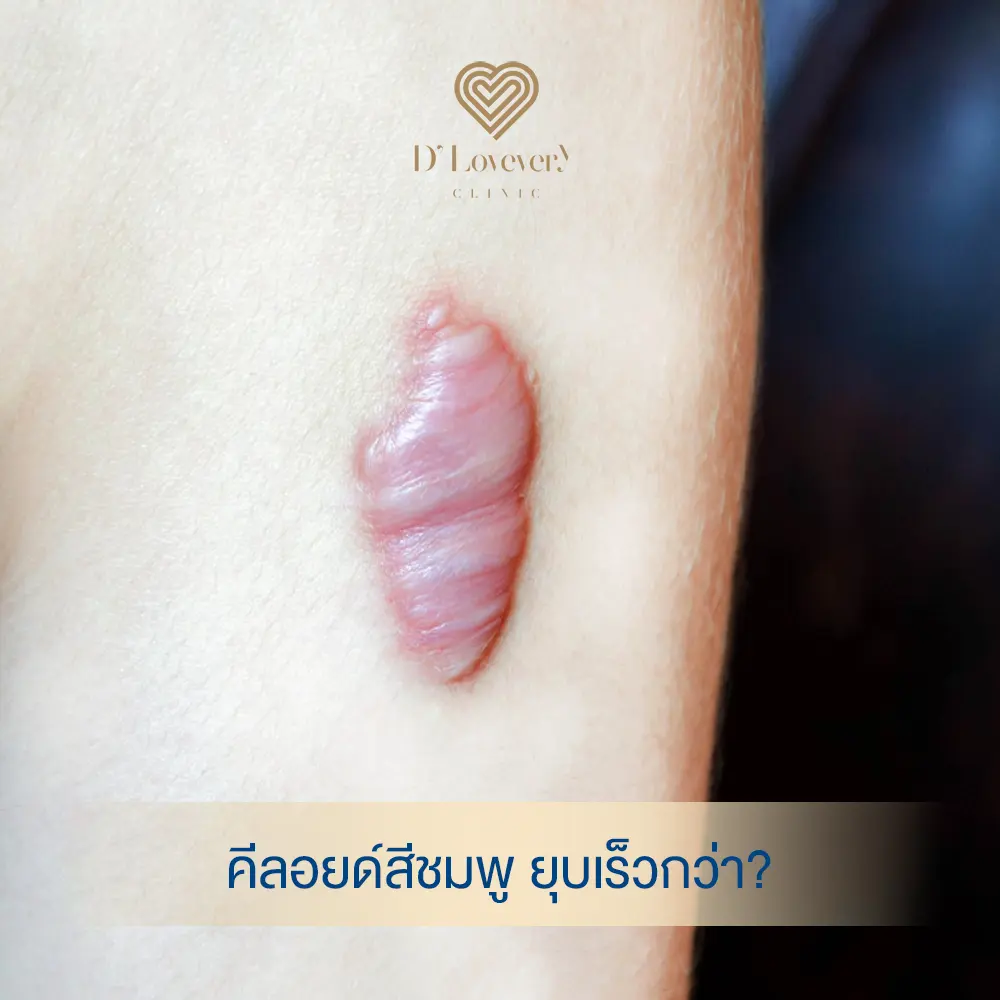 Close-up pink keloid nodule on light skin, glossy lobulated raised scar
