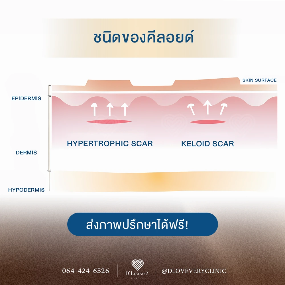 คีลอยด์มีกี่แบบ ฉีดคีลอยด์ ใกล้ฉัน คลินิก ใกล้ฉัน