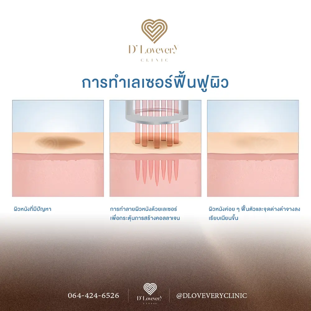Fractional laser skin resurfacing before and after results
