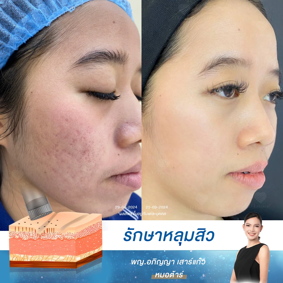 [รักษาหลุมสิว คนอายุน้อยได้เปรียบ] รีวิวฟื้นฟูหลุมสิว Rolling ด้วย Microneedling และ Growth Factor ประสบการณ์ตรง คุณผู้หญิงอายุ 20 ต้นๆ