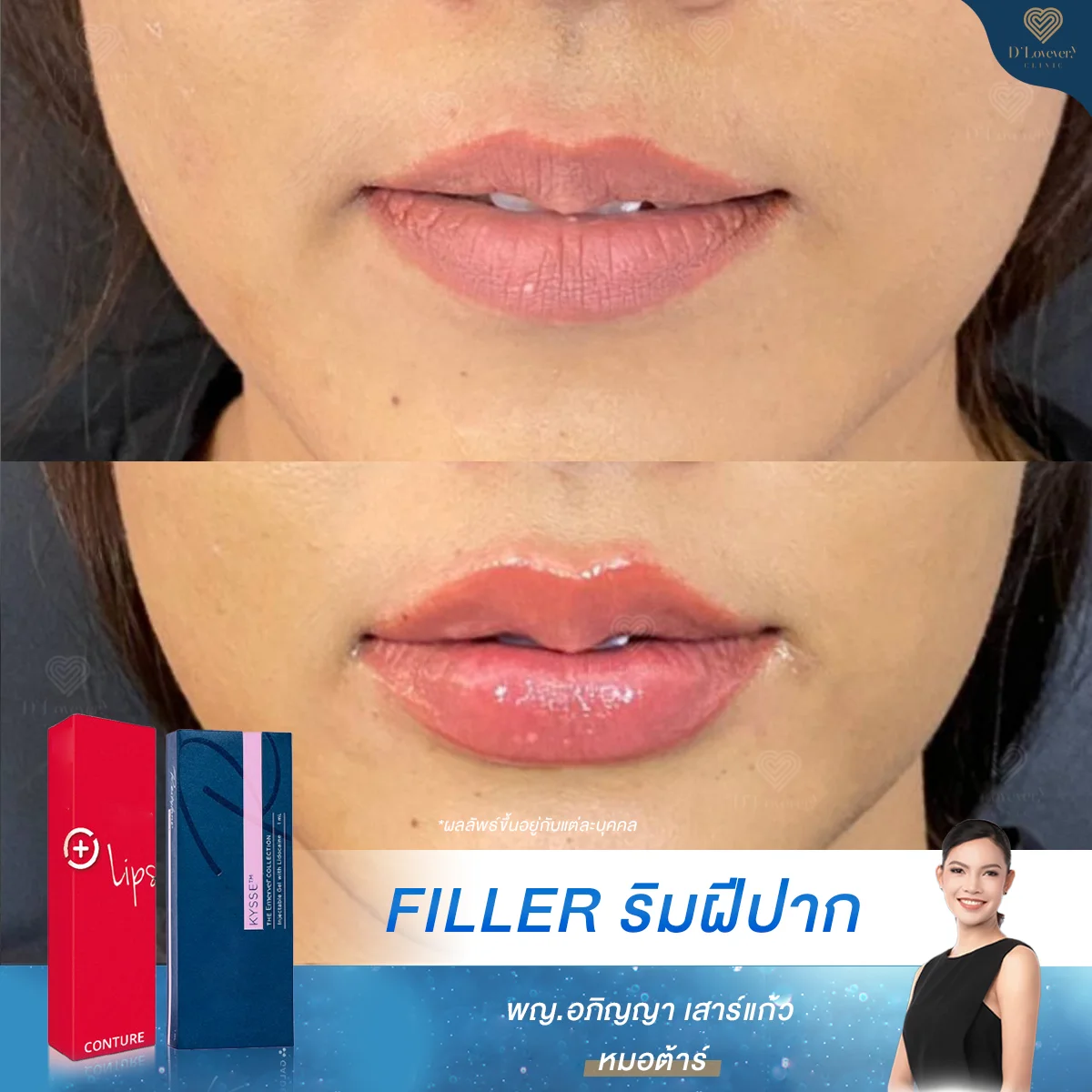 รีวิวจริง ฟิลเลอร์ปากแก้ปากแห้ง ร่องลึก ปากเด็กขึ้นทันใจ มั่นใจทุกมุมมอง