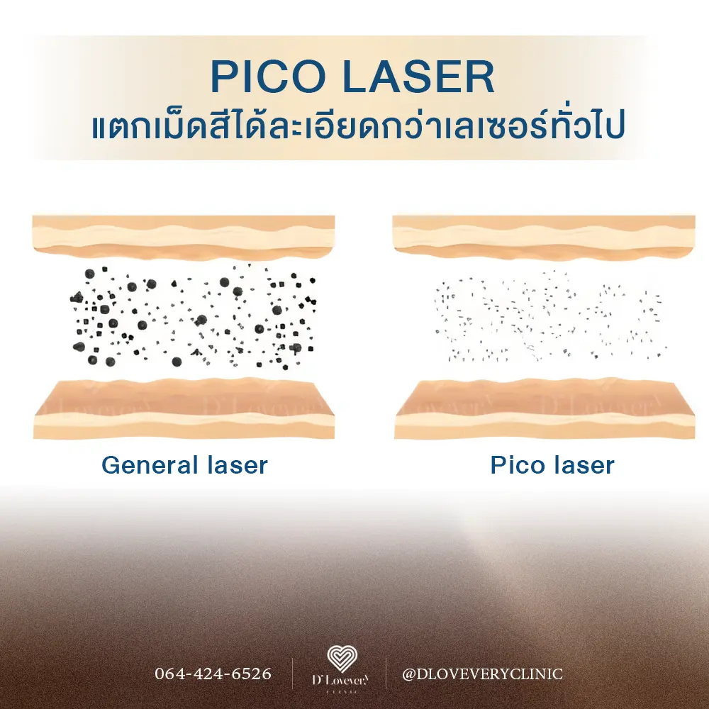 Laser Pico loại bỏ sắc tố hiệu quả hơn so với các loại laser khác đã có trước đây.