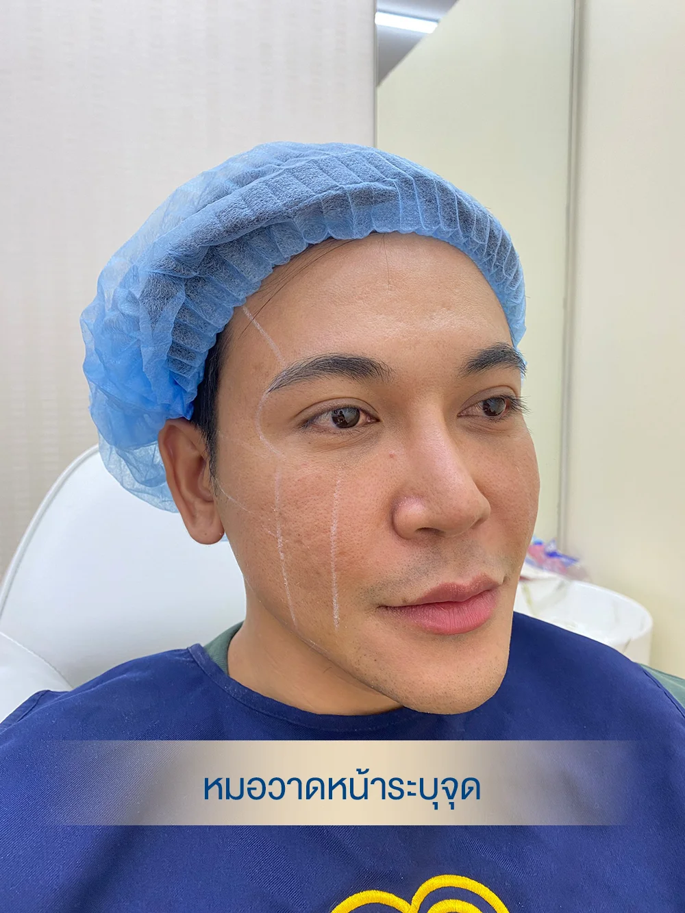 ลงมาร์กจุดวางยา Sculptra ตามแนวปรับรูปหน้า