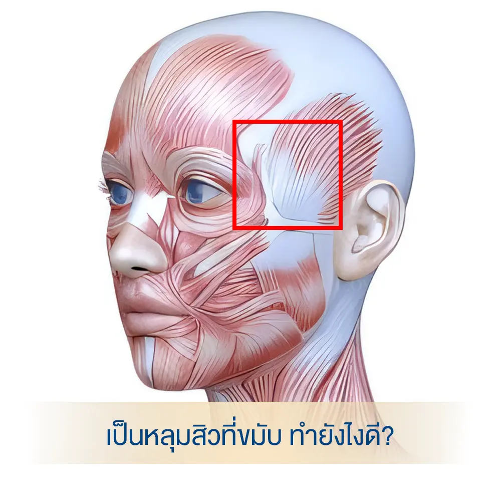 Anatomical illustration of a pitted acne scar (depression) at the temple